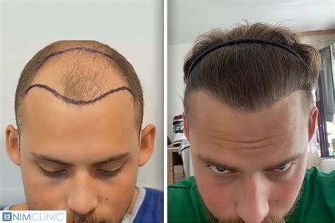 hermes hair transplant|hair transplant in turkey.